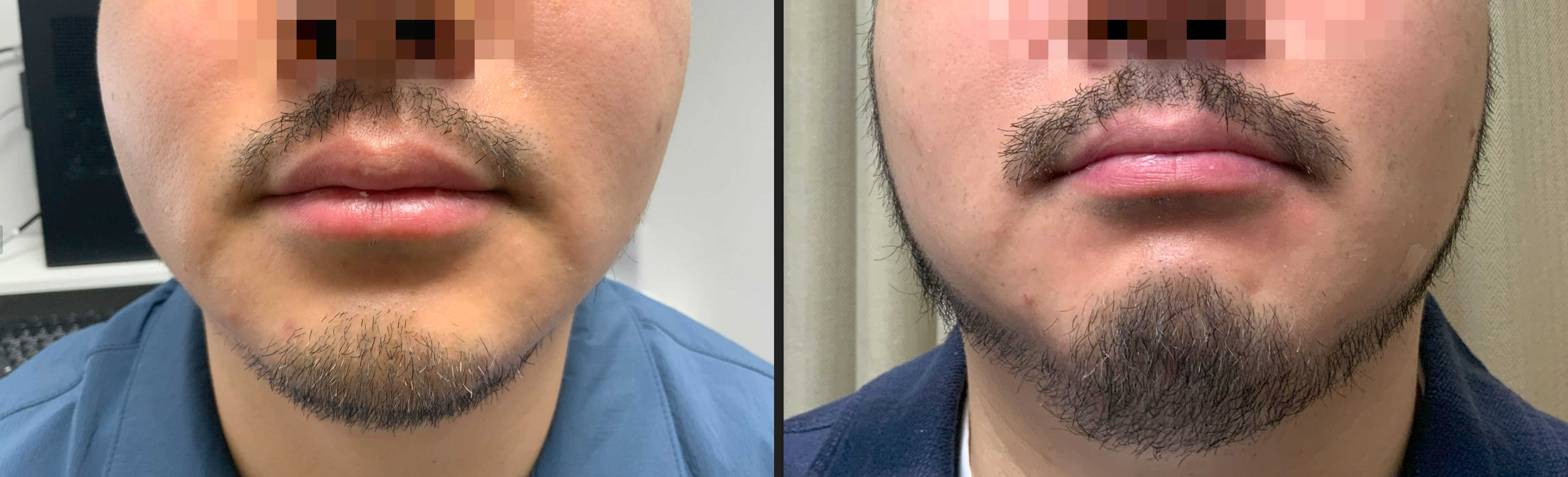 /filedata/md_board/20260129213502_J4EUwYaC_KakaoTalk_20260129_212949062_02.png 전후사진